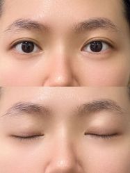 -广州健丽·去眼袋医疗美容机构