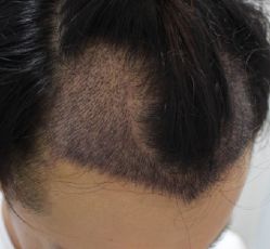 -大麦微针植发全国连锁