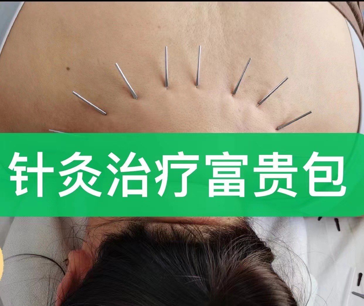 针灸富贵包,分享来了
