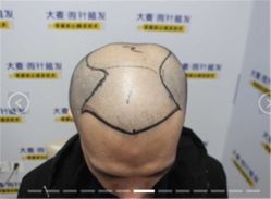 -大麦微针植发丨全国连锁