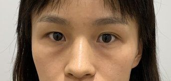 -广州健丽·去眼袋医疗美容机构