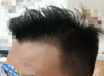 -大麦微针植发丨全国连锁