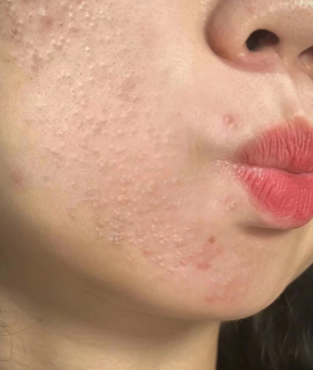 你为什么长闭口痘痘