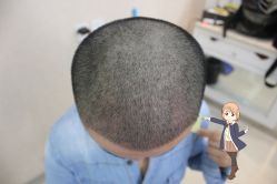 -大麦微针植发丨全国连锁