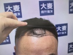 点击看大图 -大麦微针植发丨全国连锁