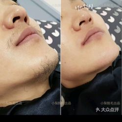 点击看大图 -小梨·OndaPro·专业脱毛连锁机构