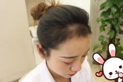 -大麦微针植发丨全国连锁