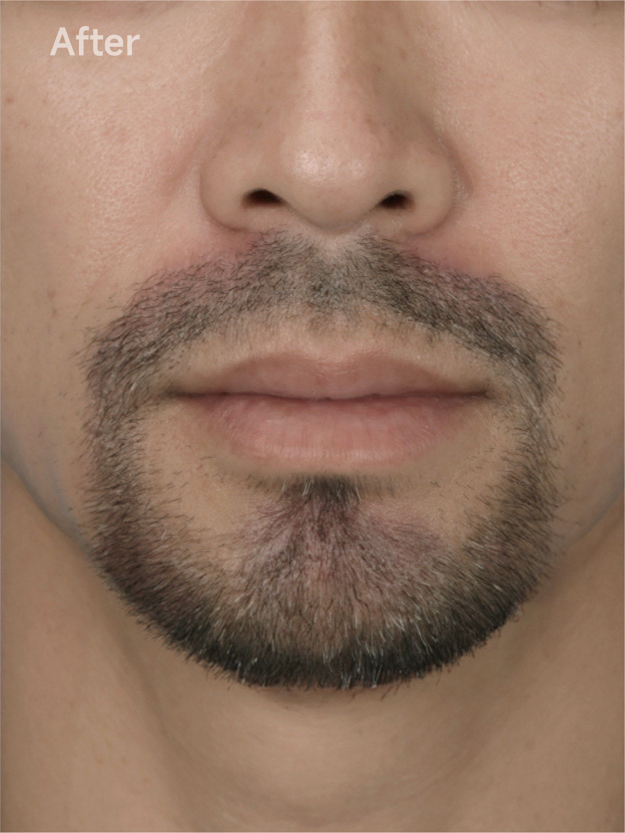 「苇渡植发育发 pherrimed」
很多男生都觉得,胡须是成熟男人的标志