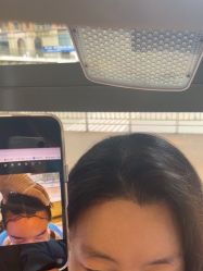 -碧莲盛·不剃发植发