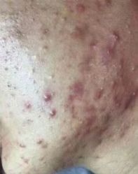 -苗方清颜痘肌研究所