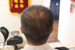 点击看大图 -大麦微针植发丨全国连锁