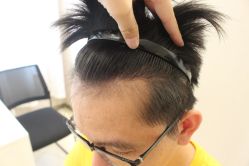 -大麦微针植发丨全国连锁