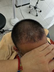 -大麦微针植发丨全国连锁