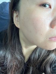 体验后-针美汇欧邦医疗美容