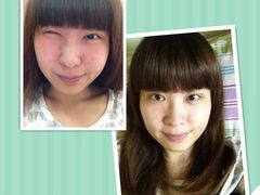 第9天眼睛（可陪同有优惠券哦）-上海华安整形外科门诊部