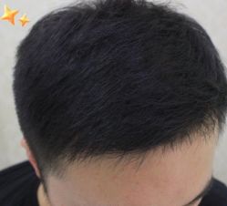 -大麦微针植发丨全国连锁