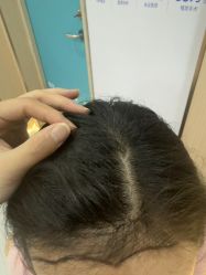 -碧莲盛不剃发植发