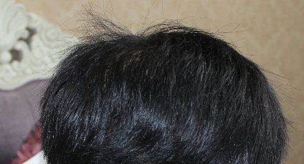 -大麦微针植发丨全国连锁