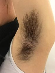 -薇兰专业脱毛连锁机构