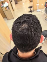 -大麦微针植发丨全国连锁