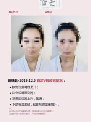 -溢美古法抗衰