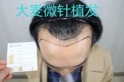 -大麦微针植发丨全国连锁