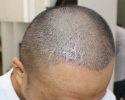 -大麦微针植发全国连锁