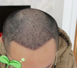 -大麦微针植发丨全国连锁