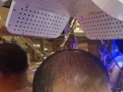 -碧莲盛·不剃发植发