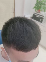 -大麦微针植发丨全国连锁