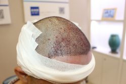 -大麦微针植发丨全国连锁