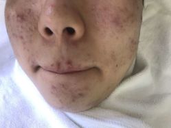 -蕾特恩·专业祛痘国际连锁