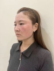 -海涛医疗美容·面部抗衰·注射美鼻