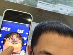 -碧莲盛·不剃发植发