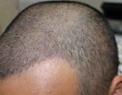 -大麦微针植发全国连锁