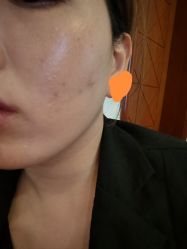 体验前-苏州卫康美容医院