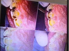 -上海仁爱医院口腔科 · 种植