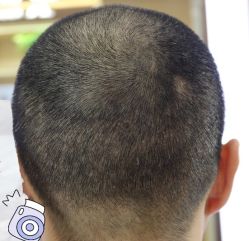 -大麦微针植发丨全国连锁