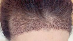 -大麦微针植发全国连锁