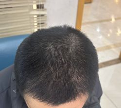 -大麦微针植发丨全国连锁