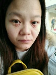 当天做完的样子-美丽人生祛斑扁平疣汗管瘤中心