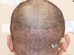 -大麦微针植发全国连锁