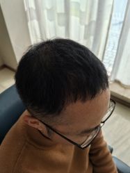 -大麦微针植发丨全国连锁