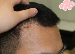 -大麦微针植发丨全国连锁