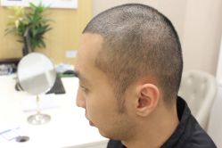 点击看大图 -大麦微针植发丨全国连锁