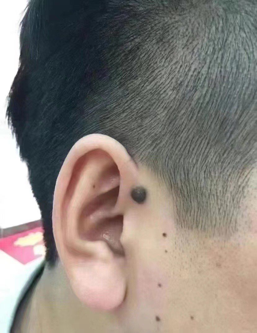 97今日释痣:
耳前有明痣,定是散金痣,.