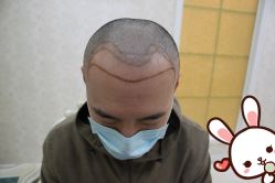 点击看大图 -大麦微针植发丨全国连锁