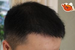 -大麦微针植发丨全国连锁