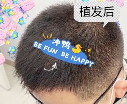 -大麦微针植发全国连锁