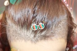 -大麦微针植发全国连锁